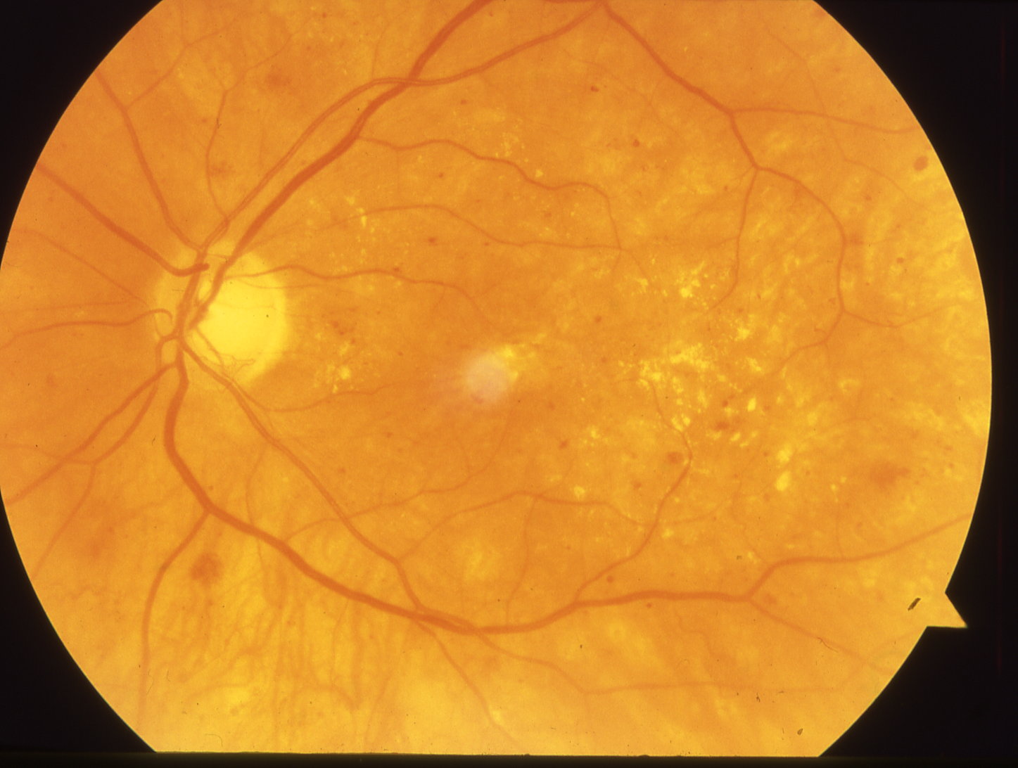 Макулопатия глаза. Диабетическая ретинопатия сетчатки. Макулопатия макулярный отек. Неоваскулярная макулодистрофия. Пролиферативная ретинопатия.