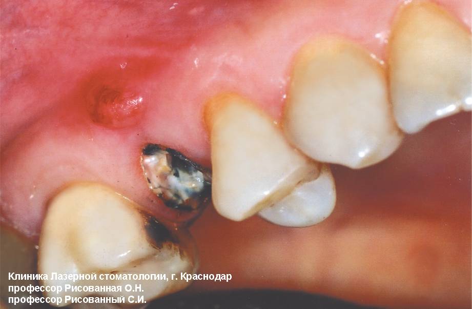 Гранулематозный периодонтит 15 зуба со свищевым ходом до лечения
