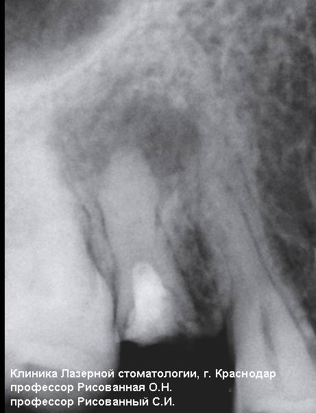 Гранулематозный периодонтит 15 зуба со свищевым ходом. Рентгеновский снимок до лечения
