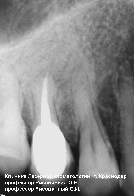 Рентгеновский снимок 15 зуба через два года после лечения, фотосенсибилизатор радахлорин, лазерный аппарат Милон-Лахта