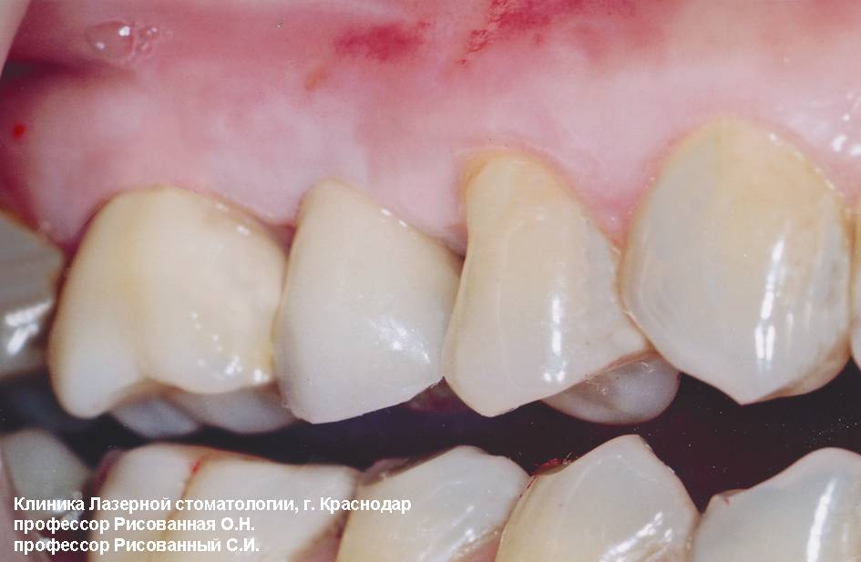 Состояние полости рта в области 15 зуба через два года после БТС-терапии, фотосенсибилизатор радахлорин, лазерный аппарат Милон-Лахта