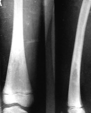 Бедренная кость через 11 месяцев после лазерной остеоперфорации, лазерный аппарат Милон-Лахта, лазерный аппарат ЛСП