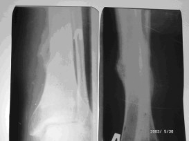 Большеберцовая кость через 2 месяца после лазерной остеоперфорации, лазерный аппарат Милон-Лахта, лазерный аппарат ЛСП