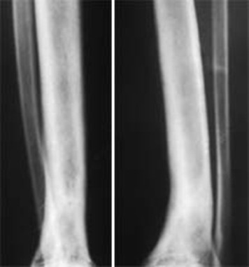 Большеберцовая кость через 9 месяцев после лазерной остеоперфорации, лазерный аппарат Милон-Лахта, лазерный аппарат ЛСП