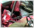 Имплантация артерии 